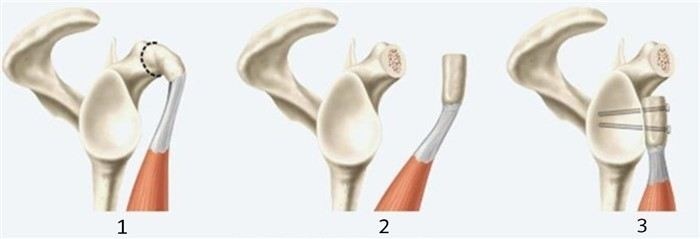 Операция Латарже на плечевом суставе: показания и особенности