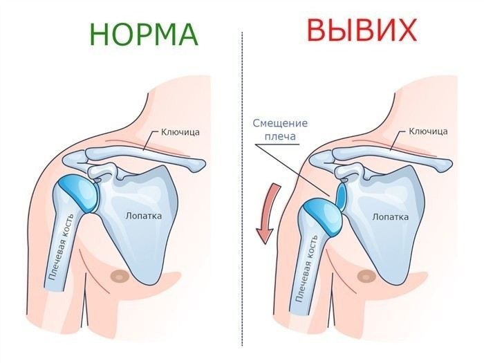 Как разрыв суставной губы влияет на призывную пригодность