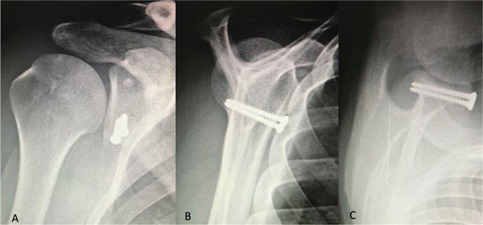 Послеоперационная реабилитация и возвращение к службе: сроки и рекомендации
