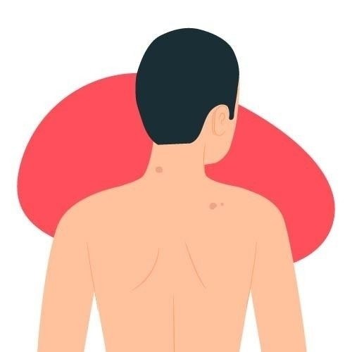 Что такое бородавка и как она влияет на здоровье призывника?