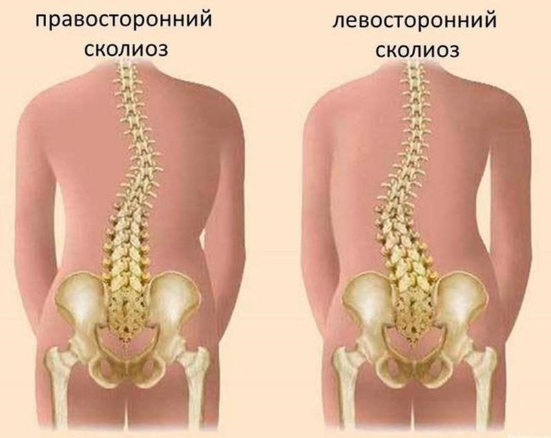 Что делать, если у вас другой диагноз сколиоза?