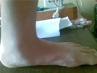 Какие стадии плоскостопия учитываются при призыве на военную службу?