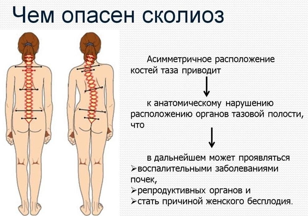 Что такое сколиоз и как он влияет на здоровье?
