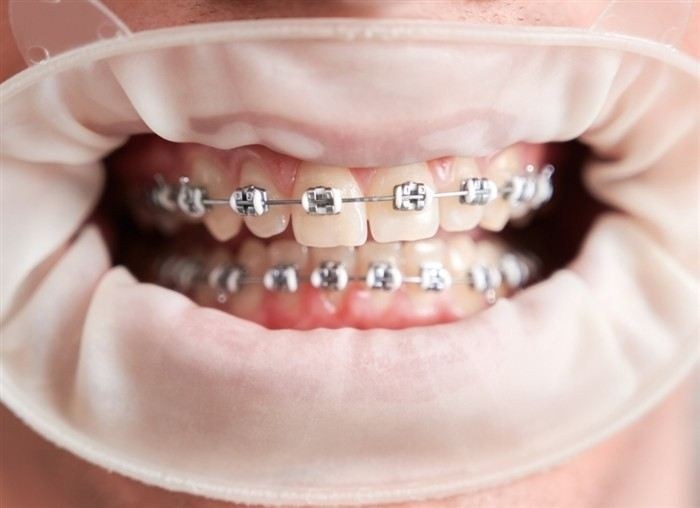 Можно ли отложить призыв на время лечения брекетами?