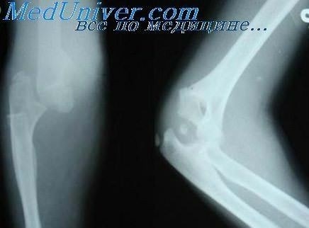 Роль активных движений в диагностике функциональных нарушений плеча