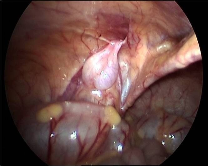 Лечение крипторхизма: хирургическое вмешательство и его необходимость