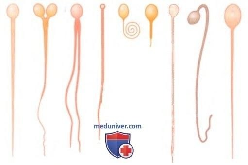 Причины отсутствия яичек в мошонке у новорожденного ребенка