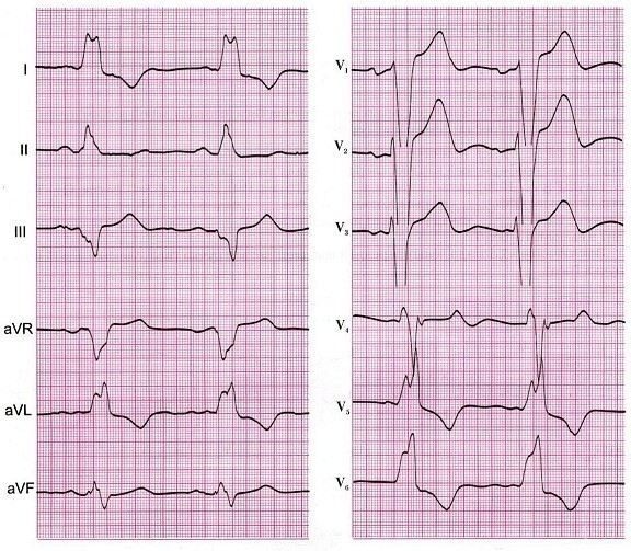 Диагностика блокады: ЭКГ и холтеровское мониторирование