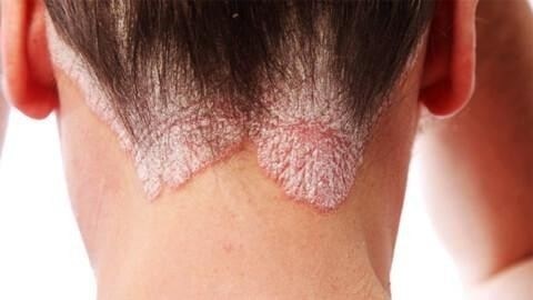 Когда призывник с псориазом считается годным к службе в армии?