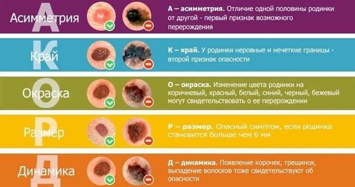 Знайте свои ABCDE: что важно помнить при осмотре родинок