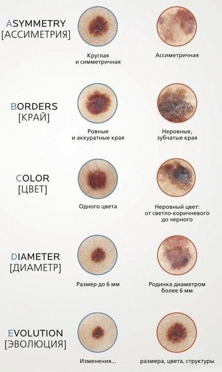 Что нужно знать пациенту о родинках: признаки доброкачественных и злокачественных образований
