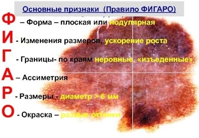 Зачем посещать дерматолога по поводу родинки: когда осмотр необходим