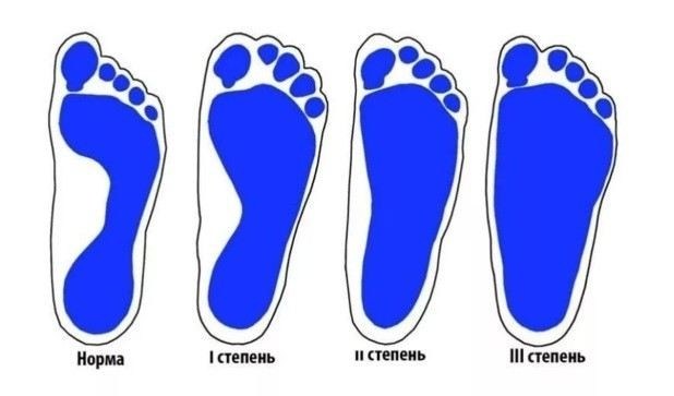 Влияние плоскостопия на военную службу: какие ограничения существуют?