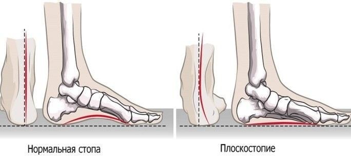 Какие симптомы плоскостопия могут стать причиной отказа от призыва
