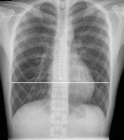Использование магнитно-резонансной томографии в диагностике воронкообразной деформации