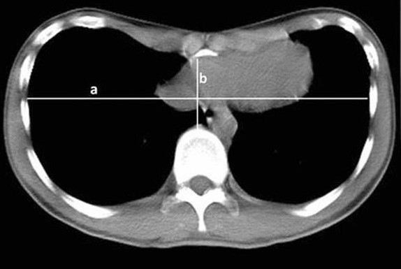 Обзор ультразвуковых методов в оценке изменений грудной клетки при воронкообразной деформации