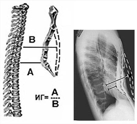 Методика измерения глубины воронкообразной деформации с помощью рентгеновских снимков