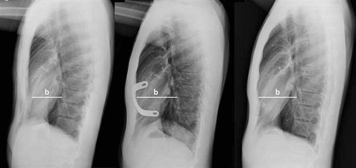 Роль компьютерной томографии в оценке степени воронкообразной деформации